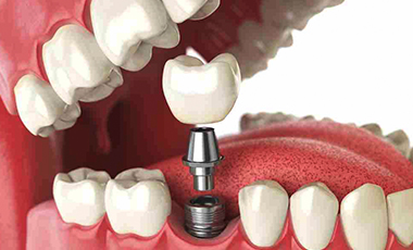 implantes dentales