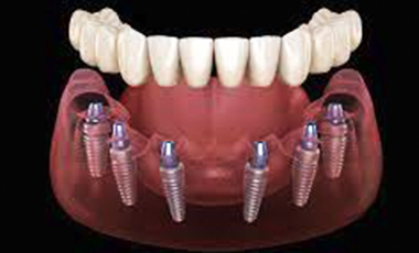 protesis dental fija